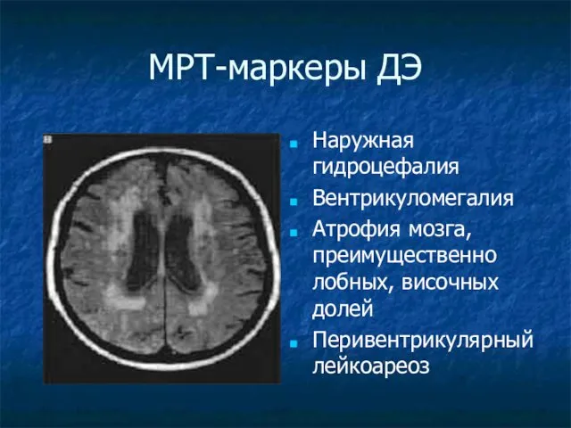 МРТ-маркеры ДЭ Наружная гидроцефалия Вентрикуломегалия Атрофия мозга, преимущественно лобных, височных долей Перивентрикулярный лейкоареоз