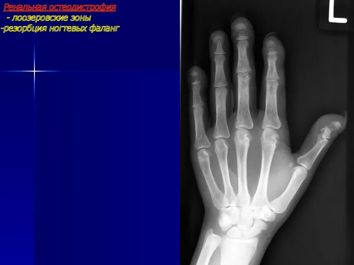 Ренальная остеодистрофия - лоозеровские зоны резорбция ногтевых фаланг