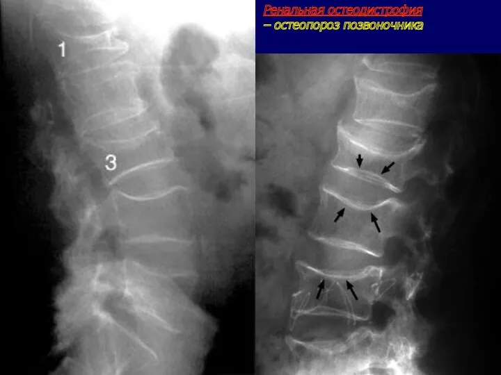 Ренальная остеодистрофия – остеопороз позвоночника