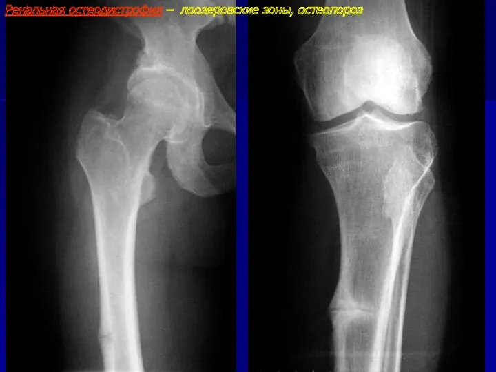 Ренальная остеодистрофия – лоозеровские зоны, остеопороз