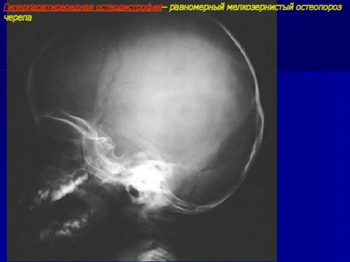 Гиперпаратиреоидная остеодистрофия– равномерный мелкозернистый остеопороз черепа