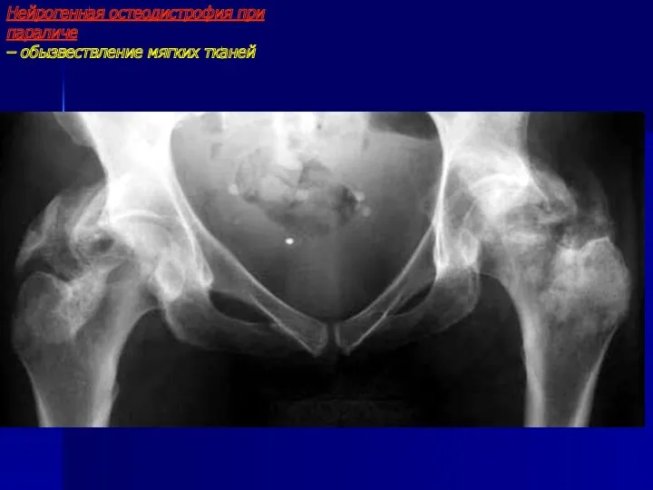 Нейрогенная остеодистрофия при параличе – обызвествление мягких тканей