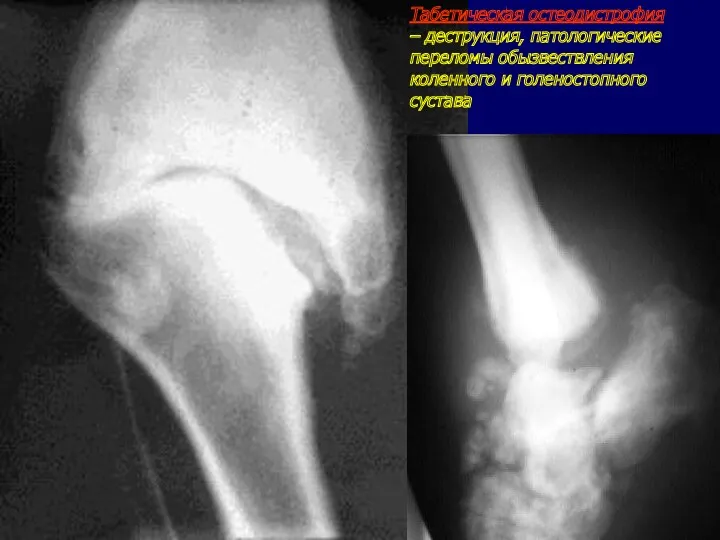 Табетическая остеодистрофия – деструкция, патологические переломы обызвествления коленного и голеностопного сустава
