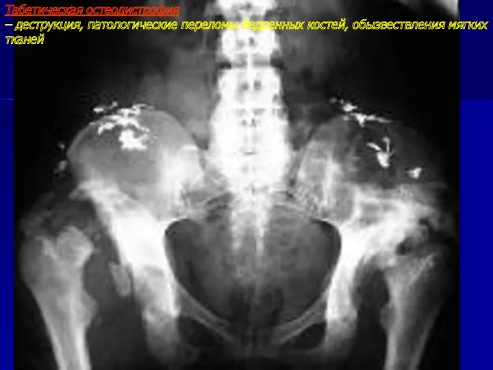 Табетическая остеодистрофия – деструкция, патологические переломы бедренных костей, обызвествления мягких тканей