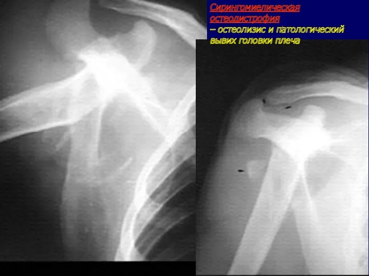 Сирингомиелическая остеодистрофия – остеолизис и патологический вывих головки плеча