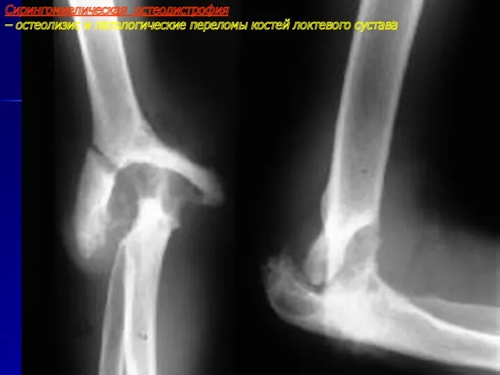 Сирингомиелическая остеодистрофия – остеолизис и патологические переломы костей локтевого сустава