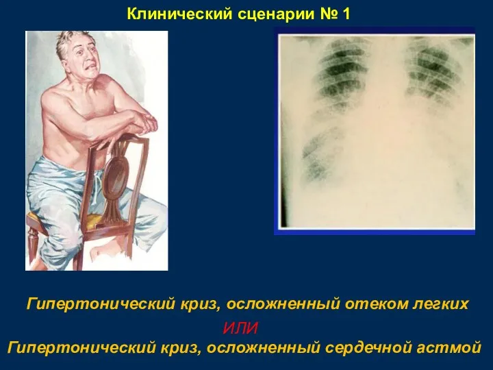 Клинический сценарии № 1 Гипертонический криз, осложненный отеком легких Гипертонический криз, осложненный сердечной астмой ИЛИ