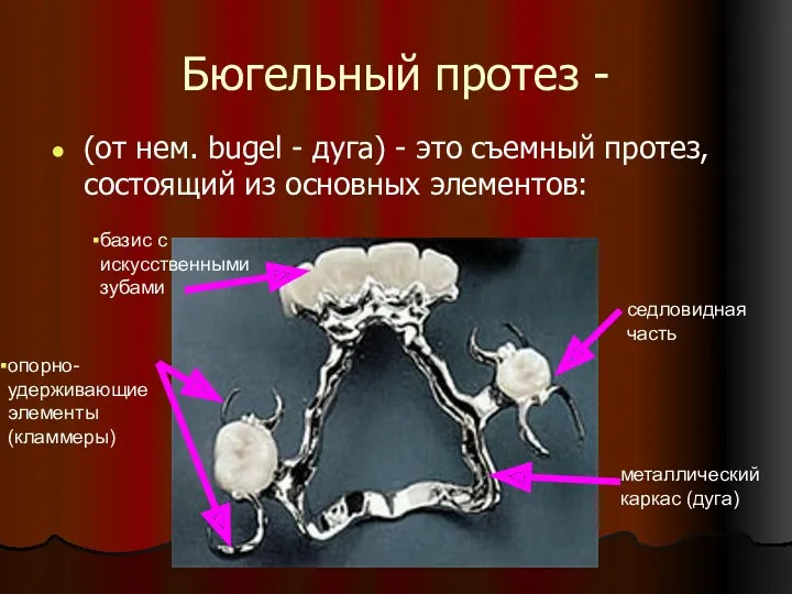 Бюгельный протез - (от нем. bugel - дуга) - это