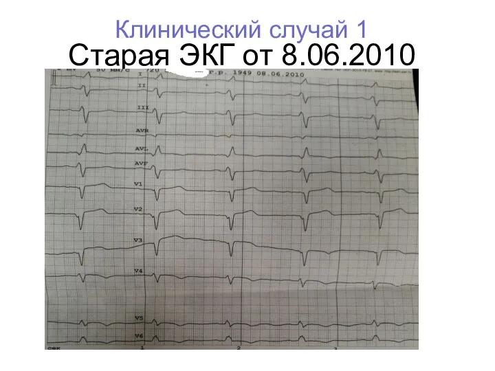 Старая ЭКГ от 8.06.2010 Клинический случай 1