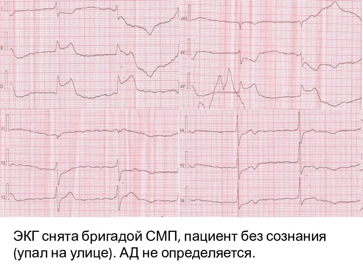 ЭКГ снята бригадой СМП, пациент без сознания (упал на улице). АД не определяется.