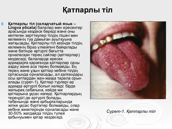 Қатпарлы тіл Қатпарлы тіл (складчатый язык – Lingva plicata) балалар