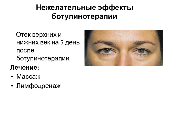 Нежелательные эффекты ботулинотерапии Отек верхних и нижних век на 5 день после ботулинотерапии Лечение: Массаж Лимфодренаж