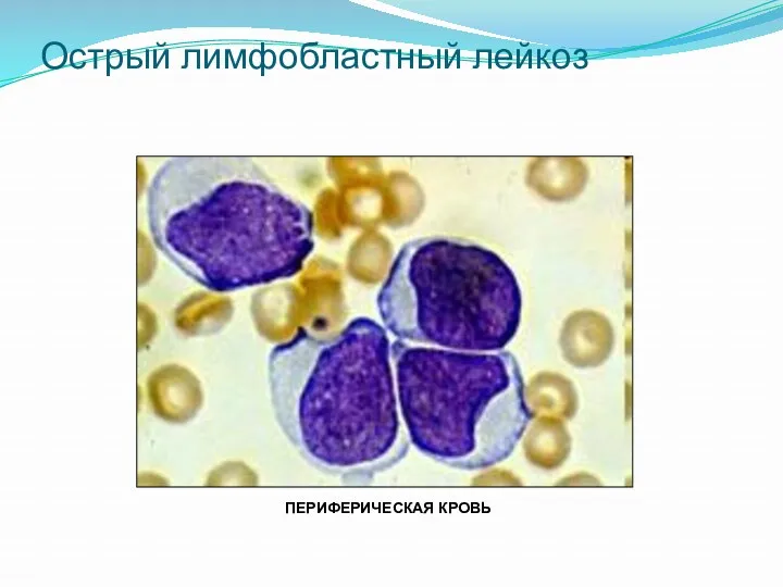 Острый лимфобластный лейкоз ПЕРИФЕРИЧЕСКАЯ КРОВЬ