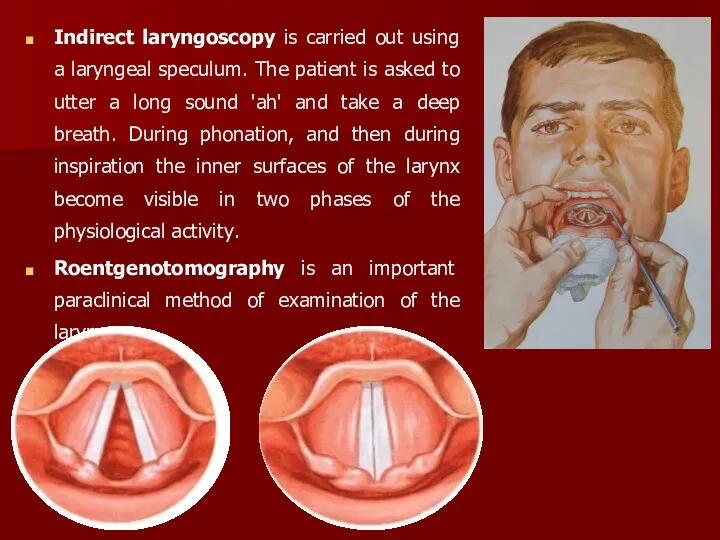 Indirect laryngoscopy is carried out using a laryngeal speculum. The