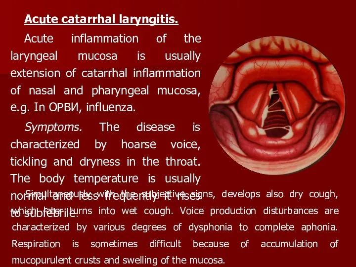 Acute catarrhal laryngitis. Acute inflammation of the laryngeal mucosa is