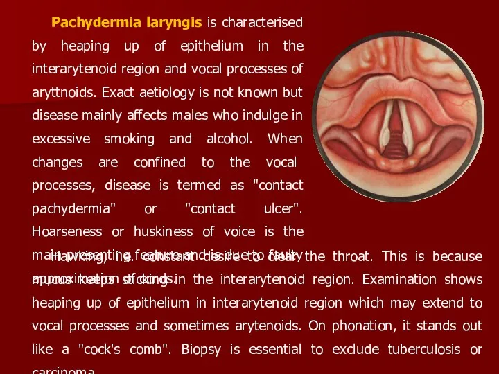 Pachydermia laryngis is characterised by heaping up of epithelium in