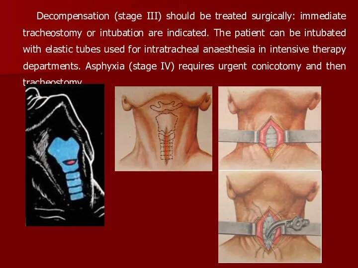 Decompensation (stage III) should be treated surgically: immediate tracheostomy or