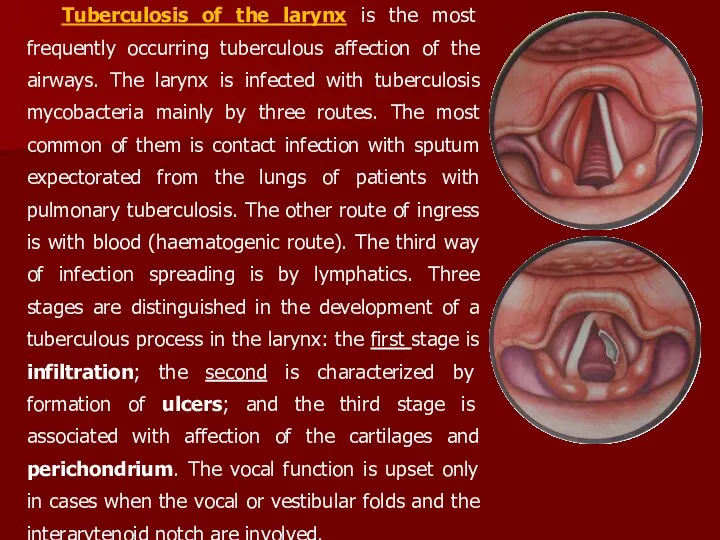 Tuberculosis of the larynx is the most frequently occurring tuberculous