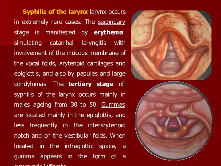 Syphilis of the larynx larynx occurs in extremely rare cases.