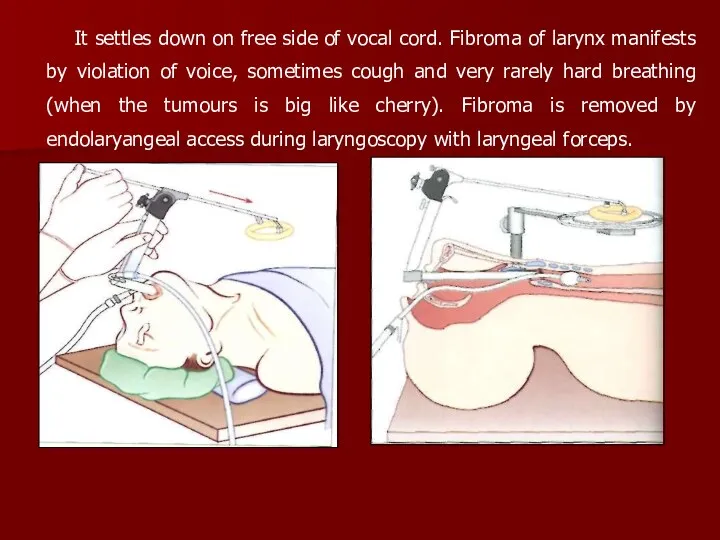 It settles down on free side of vocal cord. Fibroma