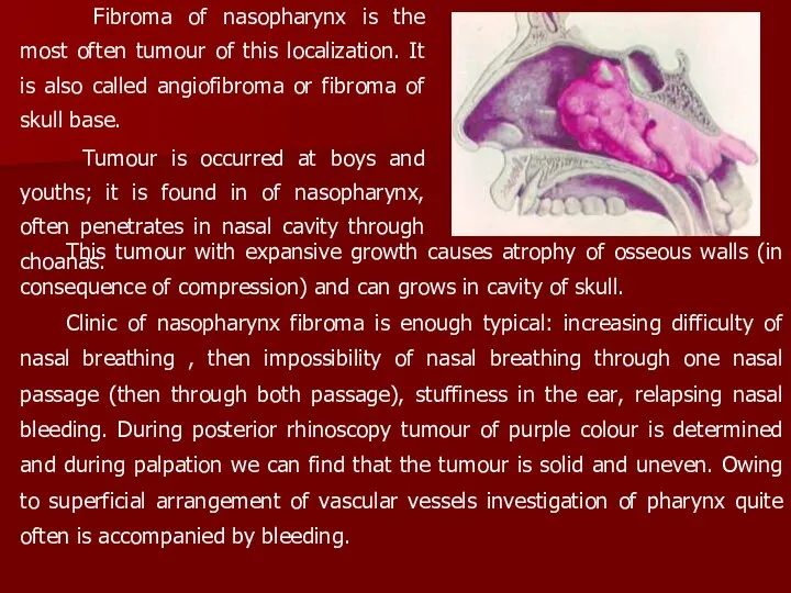 Fibroma of nasopharynx is the most often tumour of this