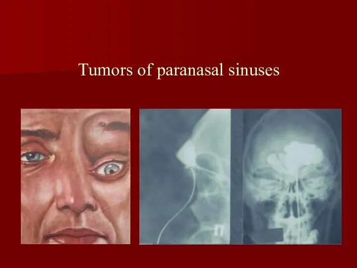 Tumors of paranasal sinuses