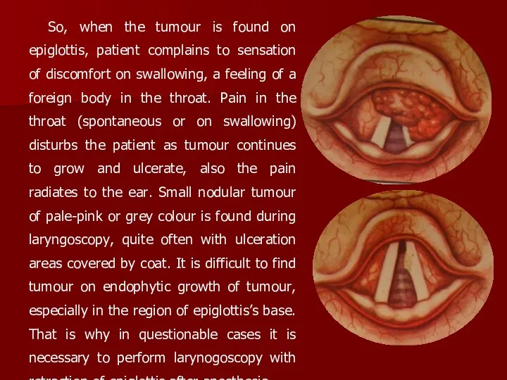 So, when the tumour is found on epiglottis, patient complains