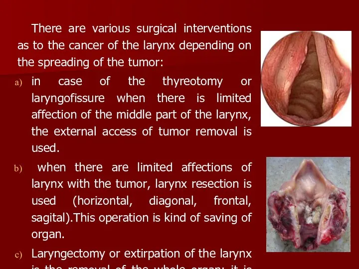 There are various surgical interventions as to the cancer of