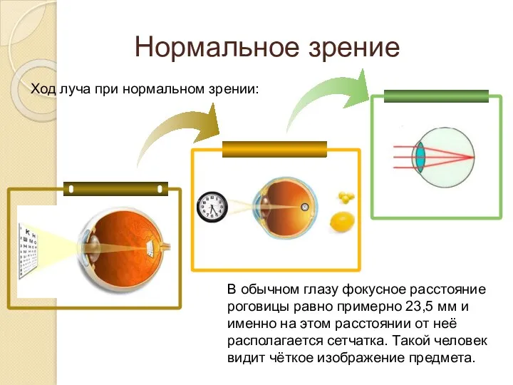 Ход луча при нормальном зрении: Нормальное зрение В обычном глазу