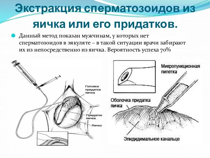 Экстракция сперматозоидов из яичка или его придатков. Данный метод показан