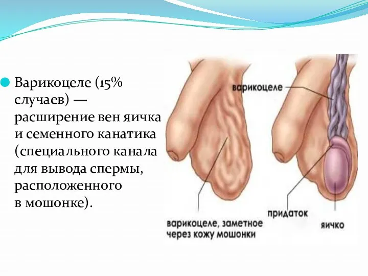 Варикоцеле (15% случаев) — расширение вен яичка и семенного канатика (специального канала для