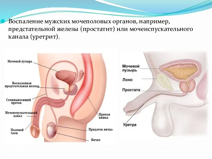 Воспаление мужских мочеполовых органов, например, предстательной железы (простатит) или мочеиспускательного канала (уретрит).