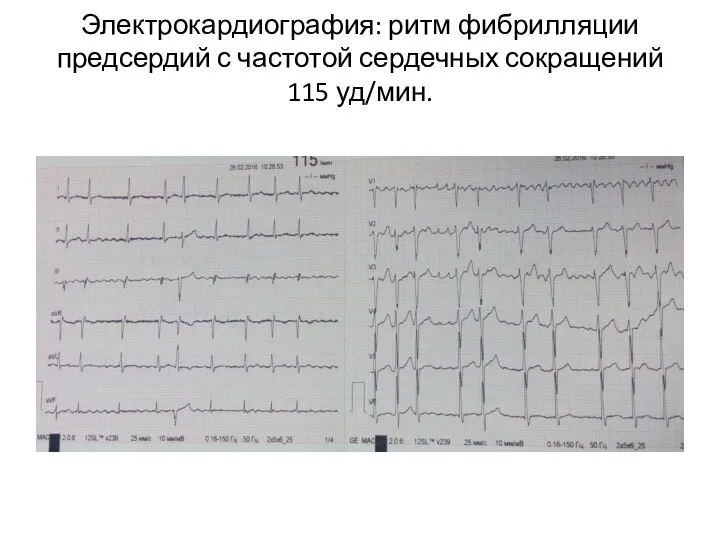 Электрокардиография: ритм фибрилляции предсердий с частотой сердечных сокращений 115 уд/мин.