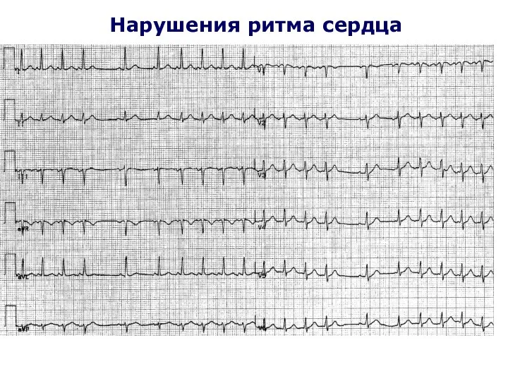 Нарушения ритма сердца