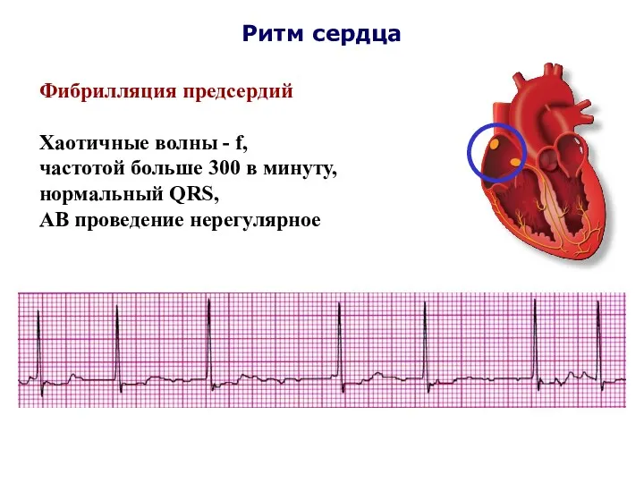 Ритм сердца Фибрилляция предсердий Хаотичные волны - f, частотой больше