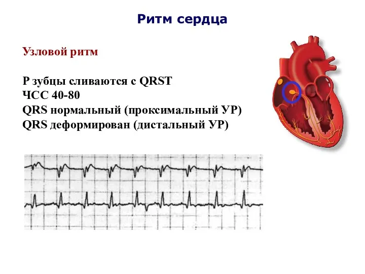 Ритм сердца Узловой ритм Р зубцы сливаются с QRST ЧСС