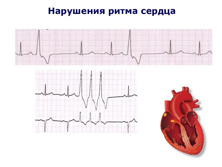 Нарушения ритма сердца