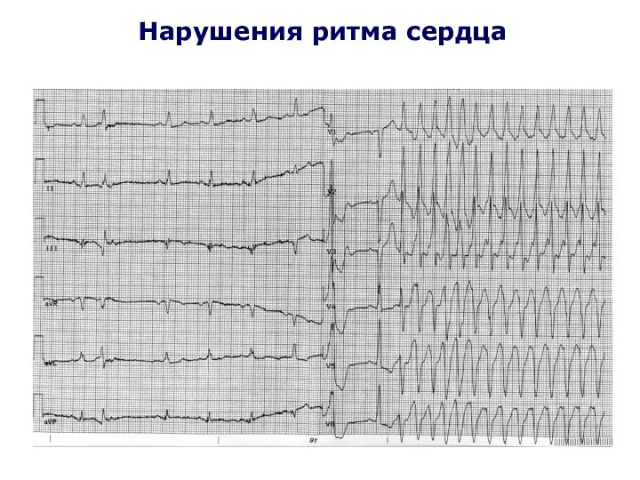 Нарушения ритма сердца