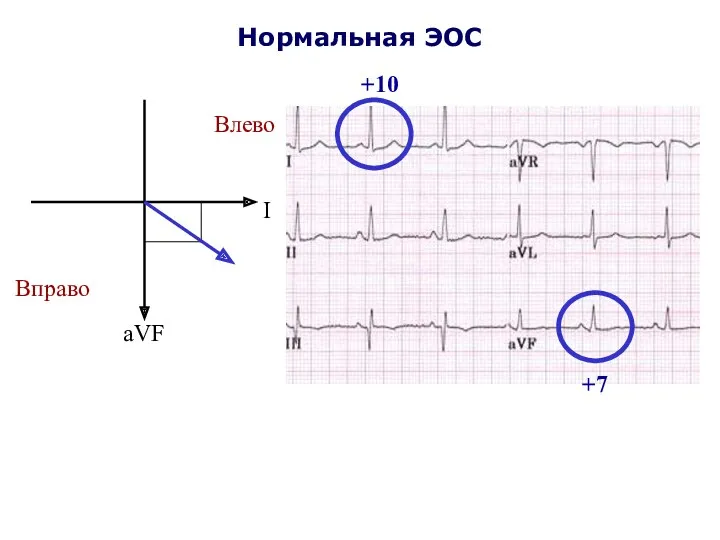 Нормальная ЭОС I aVF Влево Вправо +10 +7