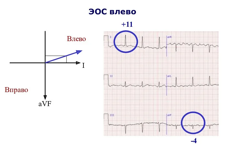 ЭОС влево I aVF Влево Вправо +11 -4