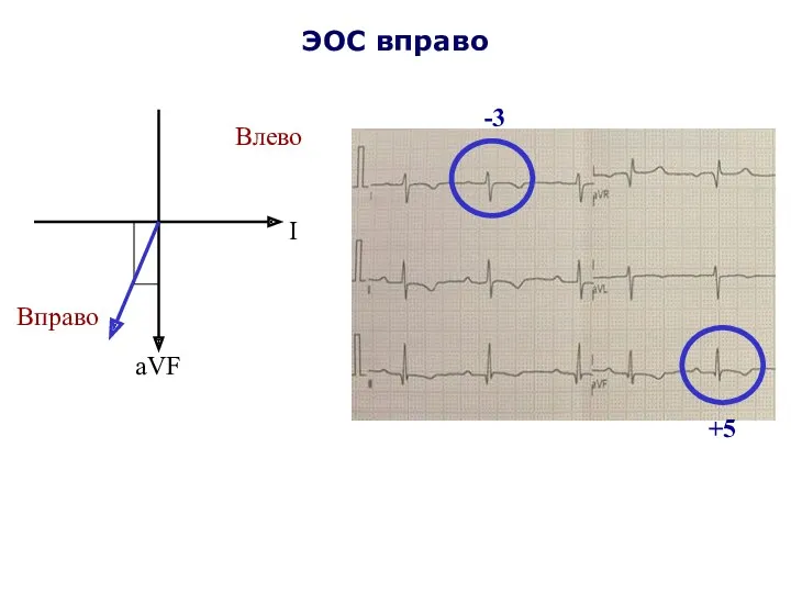 ЭОС вправо I aVF Влево Вправо -3 +5