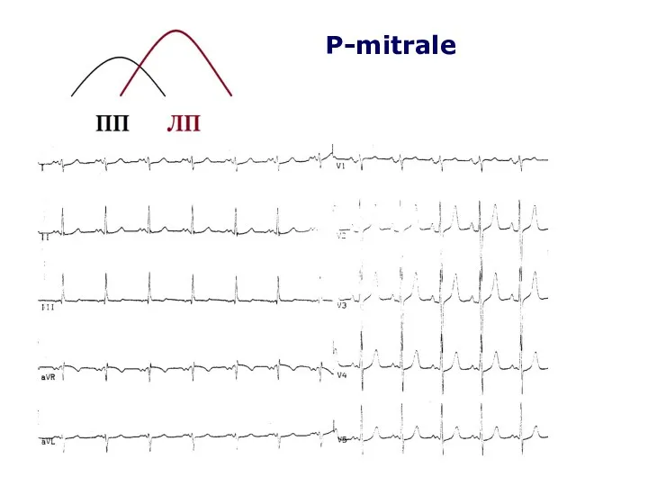 P-mitrale