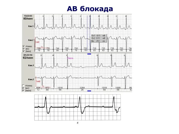 АВ блокада