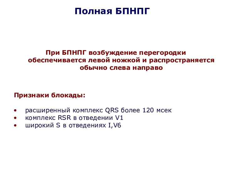 Полная БПНПГ Признаки блокады: расширенный комплекс QRS более 120 мсек