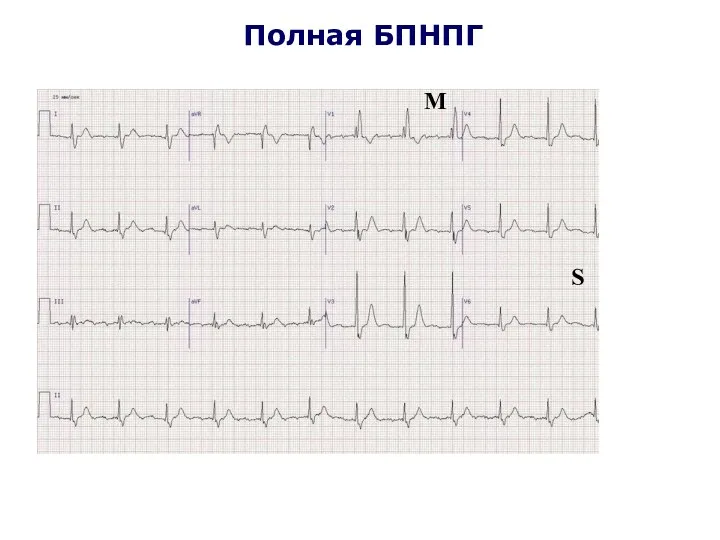 Полная БПНПГ М S