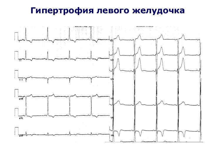 Гипертрофия левого желудочка