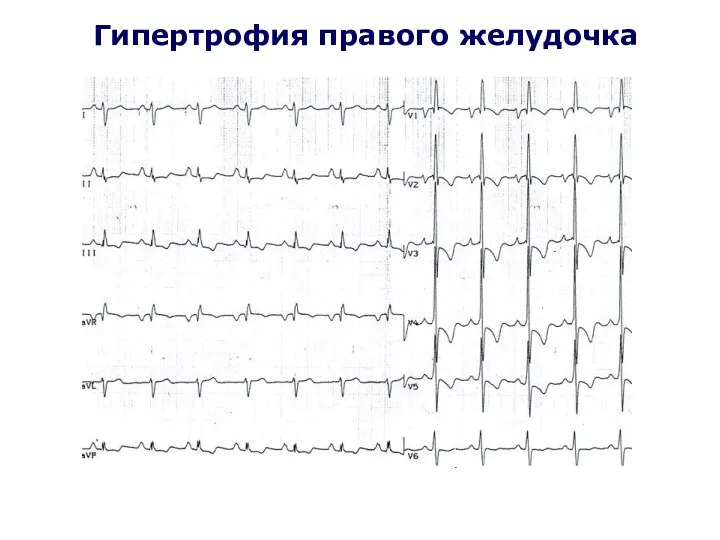 Гипертрофия правого желудочка