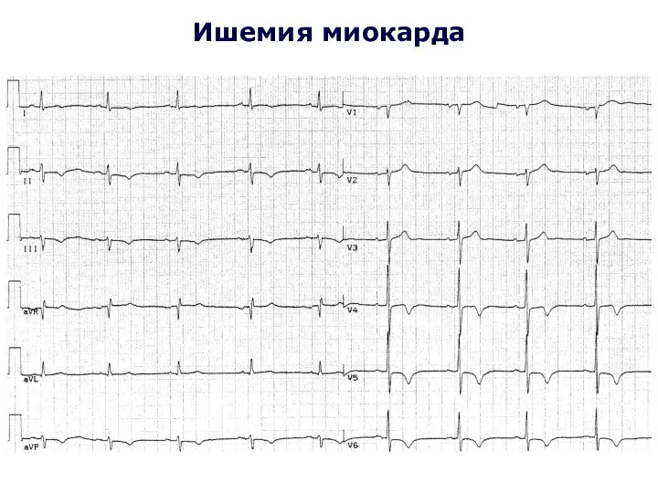 Ишемия миокарда