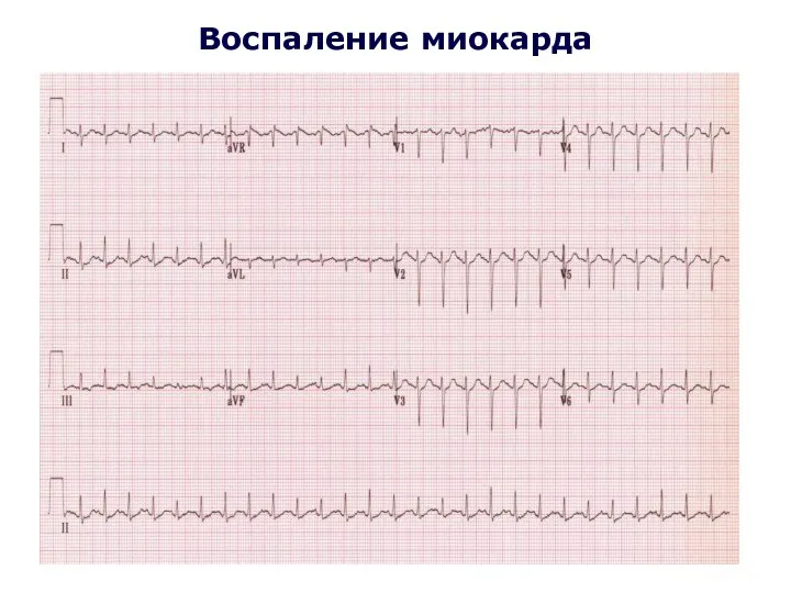 Воспаление миокарда