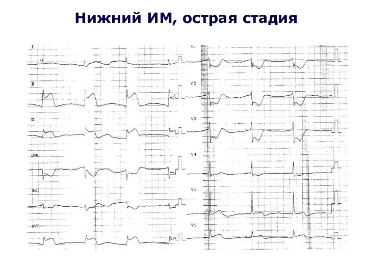 Нижний ИМ, острая стадия